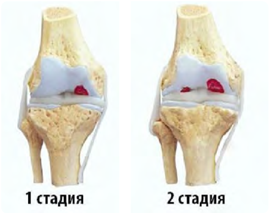 Гонартроз стандарты. Гонартроз 3 степени коленного сустава. Гонартроз коленного сустава 2 степени.